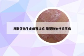 用醋蛋抹牛皮癣可以吗 醋蛋液治疗银屑病