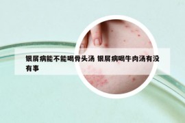 银屑病能不能喝骨头汤 银屑病喝牛肉汤有没有事
