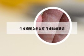 牛皮癣英文怎么写 牛皮肤癣英语