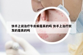 快手上说治疗牛皮癣是真的吗 快手上治疗脱发的是真的吗
