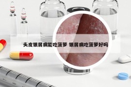 头皮银屑病能吃菠萝 银屑病吃菠萝好吗