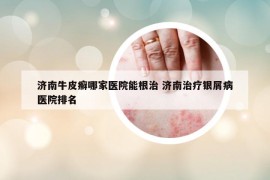 济南牛皮癣哪家医院能根治 济南治疗银屑病医院排名