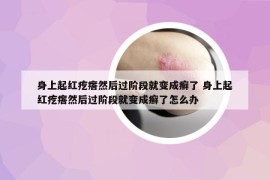 身上起红疙瘩然后过阶段就变成癣了 身上起红疙瘩然后过阶段就变成癣了怎么办
