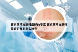 西京医院皮肤科最好的专家 西京医院皮肤科最好的专家怎么挂号