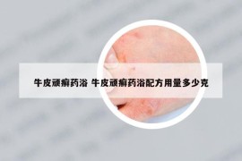 牛皮顽癣药浴 牛皮顽癣药浴配方用量多少克