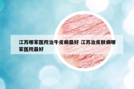 江苏哪家医院治牛皮癣最好 江苏治皮肤病哪家医院最好