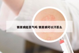 银屑病能蒸气吗 银屑病可以汗蒸么
