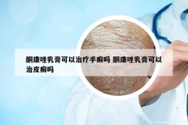 酮康唑乳膏可以治疗手癣吗 酮康唑乳膏可以治皮癣吗