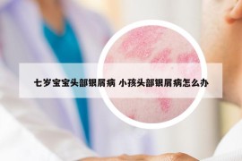 七岁宝宝头部银屑病 小孩头部银屑病怎么办