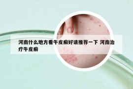 河南什么地方看牛皮癣好请推荐一下 河南治疗牛皮癣