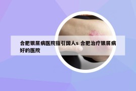 合肥银屑病医院指引国人s 合肥治疗银屑病好的医院