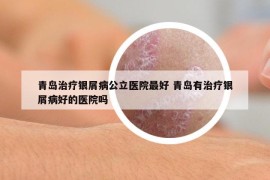 青岛治疗银屑病公立医院最好 青岛有治疗银屑病好的医院吗