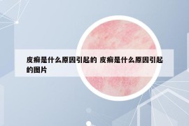 皮癣是什么原因引起的 皮癣是什么原因引起的图片