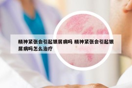 精神紧张会引起银屑病吗 精神紧张会引起银屑病吗怎么治疗