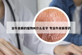 治牛皮癣的植物叫什么名字 专治牛皮癣草药