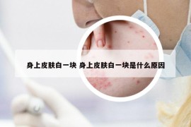 身上皮肤白一块 身上皮肤白一块是什么原因