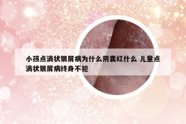 小孩点滴状银屑病为什么阴囊红什么 儿童点滴状银屑病终身不犯
