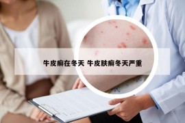 牛皮癣在冬天 牛皮肤癣冬天严重