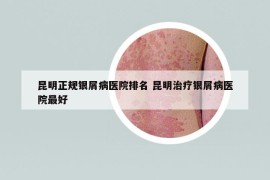 昆明正规银屑病医院排名 昆明治疗银屑病医院最好