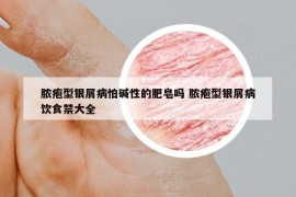 脓疱型银屑病怕碱性的肥皂吗 脓疱型银屑病饮食禁大全