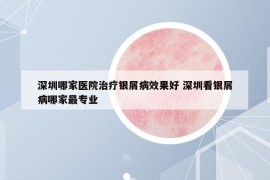 深圳哪家医院治疗银屑病效果好 深圳看银屑病哪家最专业