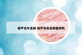 葫芦岛牛皮癣 葫芦岛有皮肤医院吗