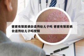 爸爸有银屑病会遗传给儿子吗 爸爸有银屑病会遗传给儿子吗视频
