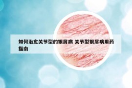 如何治愈关节型的银屑病 关节型银屑病用药指南