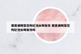 银屑病喝菊花枸杞泡水喝有效 银屑病喝菊花枸杞泡水喝有效吗