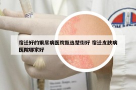 宿迁好的银屑病医院甄选楚街好 宿迁皮肤病医院哪家好