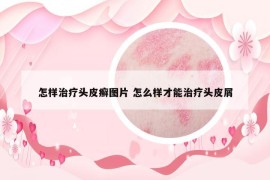 怎样治疗头皮癣图片 怎么样才能治疗头皮屑