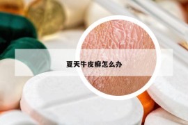 夏天牛皮癣怎么办
