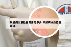 银屑病血液检查费用是多少 银屑病抽血检查项目