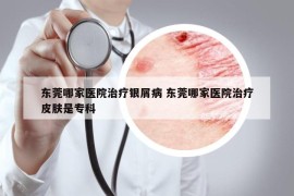 东莞哪家医院治疗银屑病 东莞哪家医院治疗皮肤是专科