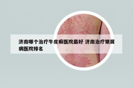 济南哪个治疗牛皮癣医院最好 济南治疗银屑病医院排名