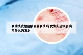 女生头皮银屑病需要剃头吗 女生头皮银屑病用什么洗发水