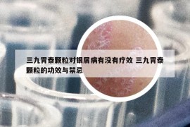 三九胃泰颗粒对银屑病有没有疗效 三九胃泰颗粒的功效与禁忌