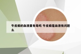 牛皮癣的血液里有毒吗 牛皮癣是血液有问题么