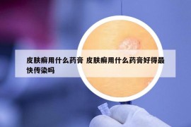 皮肤癣用什么药膏 皮肤癣用什么药膏好得最快传染吗