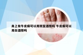 身上有牛皮癣可以用斑蝥酒擦吗 牛皮癣可以用白酒擦吗