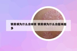 银屑病为什么会掉屑 银屑病为什么会越来越多