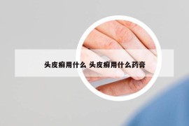 头皮癣用什么 头皮癣用什么药膏