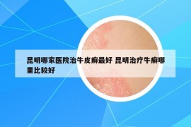 昆明哪家医院治牛皮癣最好 昆明治疗牛癣哪里比较好