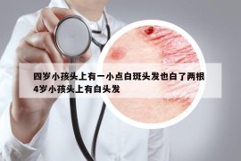 四岁小孩头上有一小点白斑头发也白了两根 4岁小孩头上有白头发