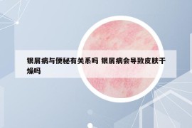 银屑病与便秘有关系吗 银屑病会导致皮肤干燥吗