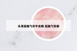 头发后脑勺长牛皮癣 后脑勺生癣