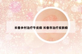长春乡村治疗牛皮癣 长春市治疗皮肤癣