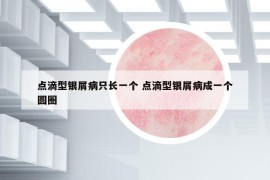 点滴型银屑病只长一个 点滴型银屑病成一个圆圈