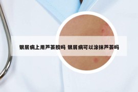 银屑病上用芦荟胶吗 银屑病可以涂抹芦荟吗