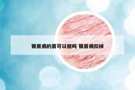 银屑病的屑可以抠吗 银屑病扣掉